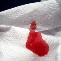 pertolongan-pertama-Epistaksis-pada-anak