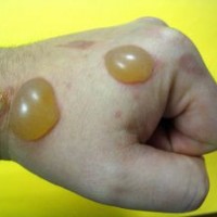 Pertolongan Pertama Luka Bakar Pada Anak