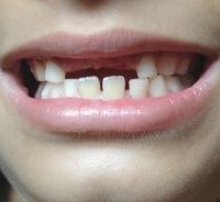 Pertolongan pertama cedera mulut pada anak